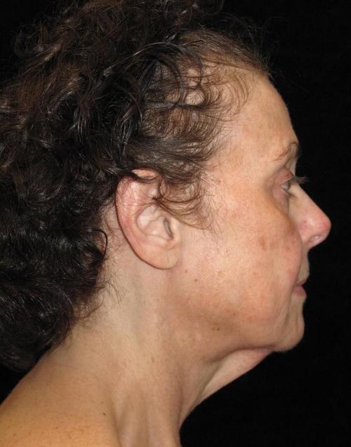 Facelift Patient Photo - Case 44 - before view-2