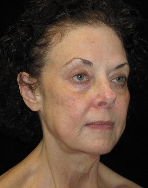 Facelift Patient Photo - Case 44 - before view-1