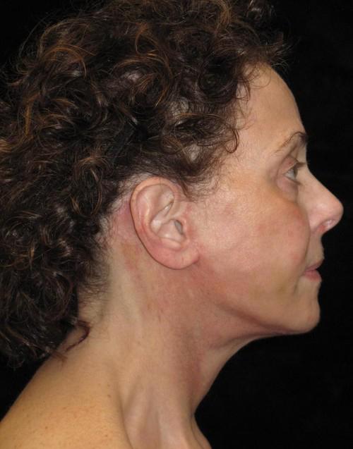 Facelift Patient Photo - Case 44 - after view-2