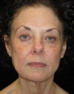 Facelift - Case 44 - Before