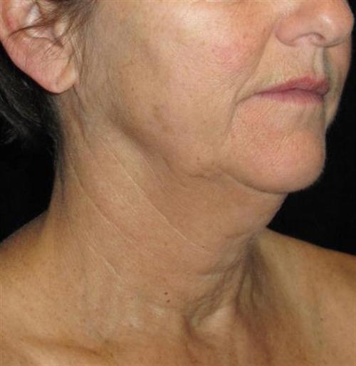 Facelift Patient Photo - Case 52 - before view-2