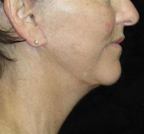 Facelift Patient Photo - Case 52 - after view-1