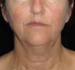 Facelift - Case 52 - Before