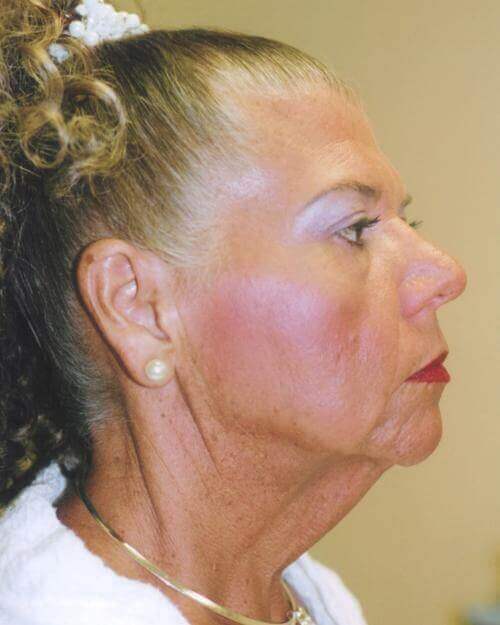 Facelift Patient Photo - Case 38 - before view-1