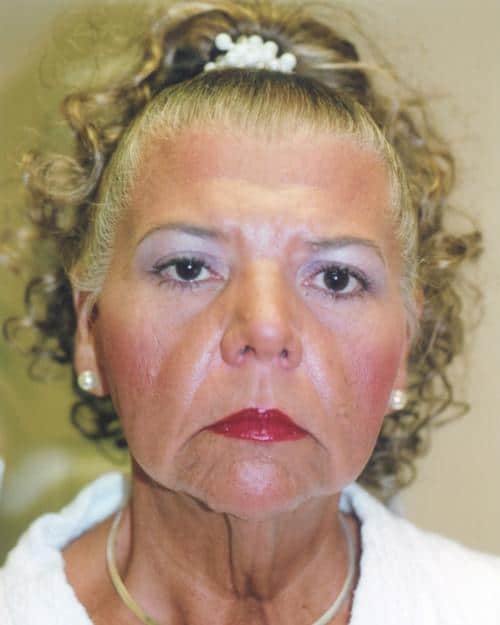 Facelift Patient Photo - Case 38 - before view-2