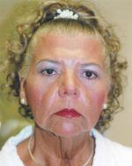 Facelift - Case 38 - Before