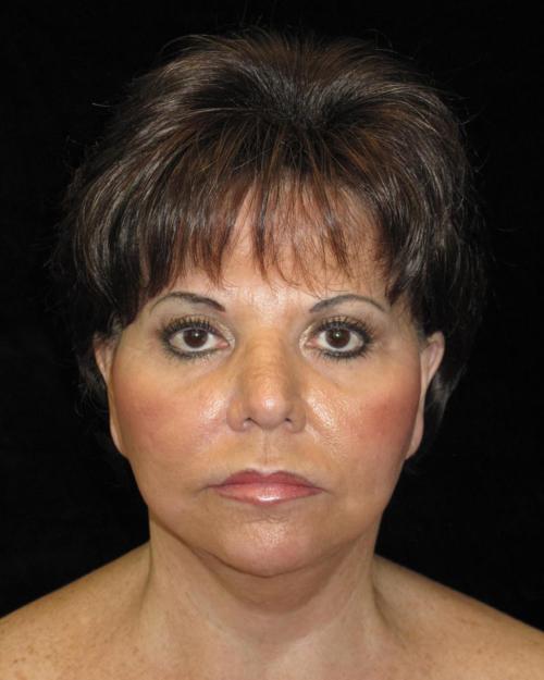 Facelift Patient Photo - Case 38 - after view-2