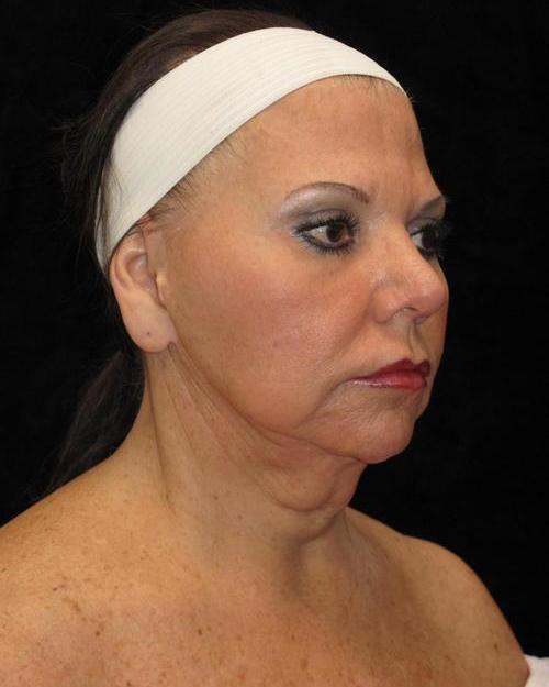 Facelift Patient Photo - Case 38 - after view-1