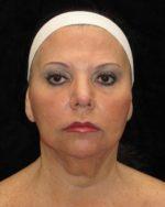 Facelift - Case 38 - After