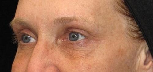 Eyelid Surgery Patient Photo - Case 49 - before view-4