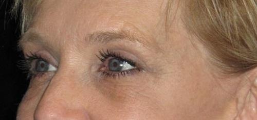 Eyelid Surgery Patient Photo - Case 49 - after view-4