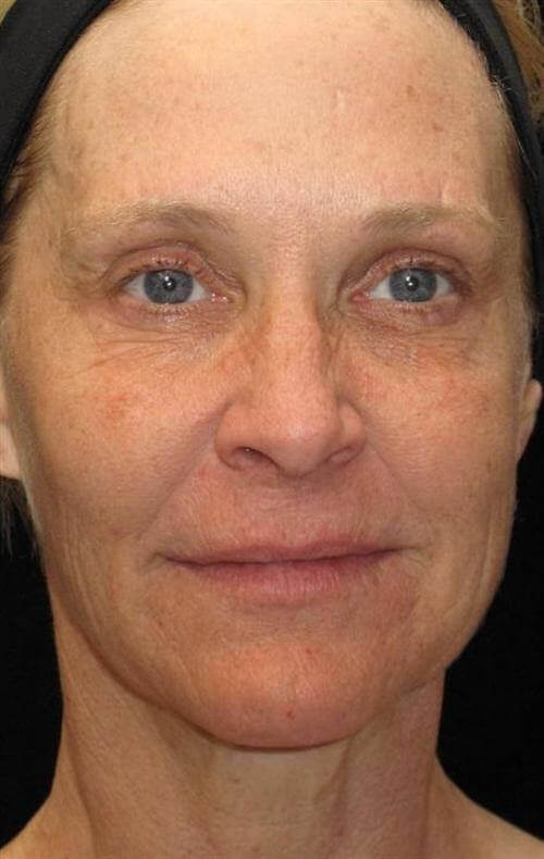 Eyelid Surgery Patient Photo - Case 49 - before view-