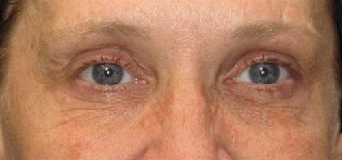 Eyelid Surgery Patient Photo - Case 49 - before view-3