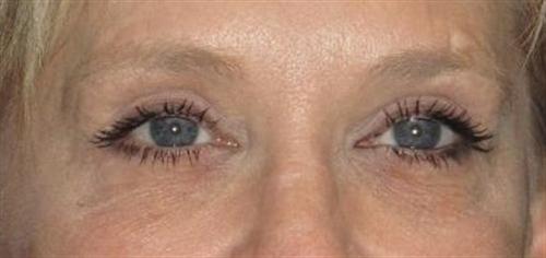 Eyelid Surgery Patient Photo - Case 49 - after view-3