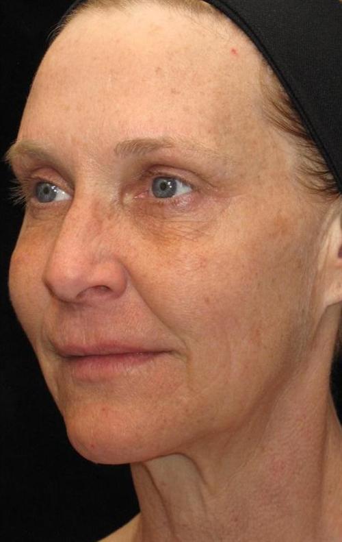 Eyelid Surgery Patient Photo - Case 49 - before view-1