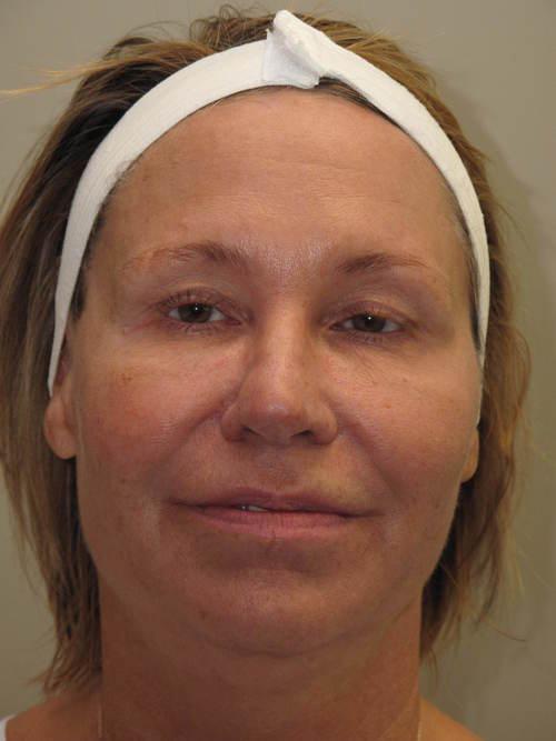 Facelift Patient Photo - Case 42 - before view-