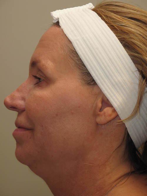 Facelift Patient Photo - Case 42 - before view-1