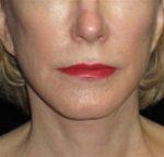 Facelift - Case 50 - After