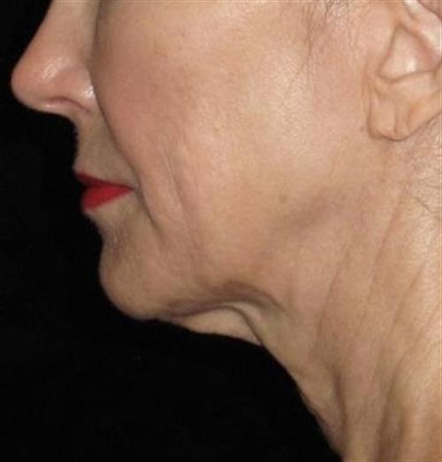 Facelift Patient Photo - Case 50 - before view-2