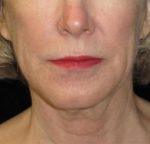 Facelift - Case 50 - Before