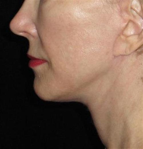 Facelift Patient Photo - Case 50 - after view-2