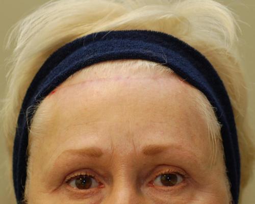 Brow Lift Patient Photo - Case 41 - after view-0