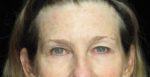 Eyelid Surgery - Case 250 - Before