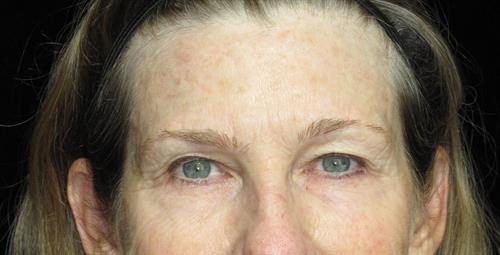 Eyelid Surgery Patient Photo - Case 250 - before view-