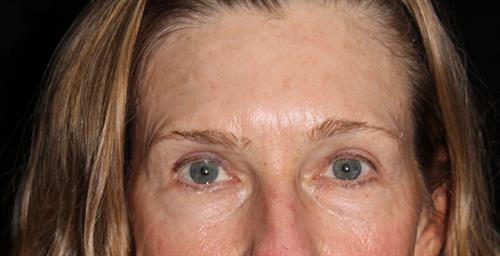Eyelid Surgery Patient Photo - Case 250 - after view-0