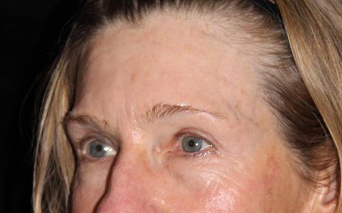 Eyelid Surgery Patient Photo - Case 250 - after view-1