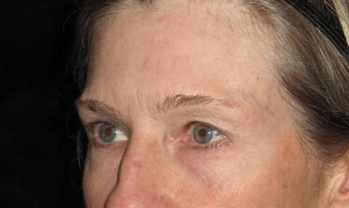 Eyelid Surgery Patient Photo - Case 250 - before view-1