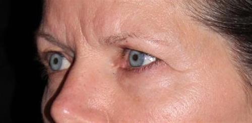 Eyelid Surgery Patient Photo - Case 248 - before view-1