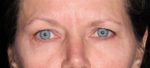 Eyelid Surgery - Case 248 - Before