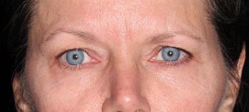 Eyelid Surgery Patient Photo - Case 248 - before view-