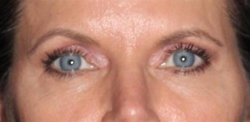 Eyelid Surgery Patient Photo - Case 248 - after view