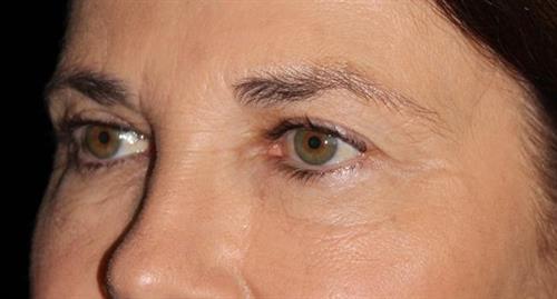 Eyelid Surgery Patient Photo - Case 249 - before view-1