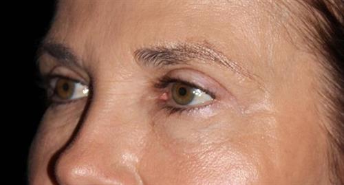 Eyelid Surgery Patient Photo - Case 249 - after view-1