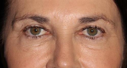 Eyelid Surgery Patient Photo - Case 249 - before view-