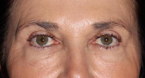 Eyelid Surgery Patient Photo - Case 249 - after view