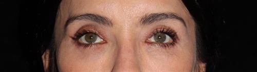 Eyelid Surgery Patient Photo - Case 247 - after view-0