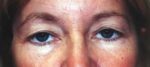 Eyelid Surgery - Case 31 - Before