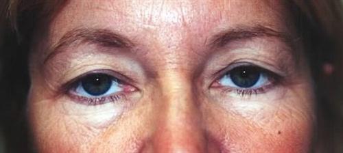 Eyelid Surgery Patient Photo - Case 31 - before view-