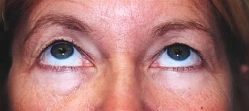 Eyelid Surgery Patient Photo - Case 31 - before view-1