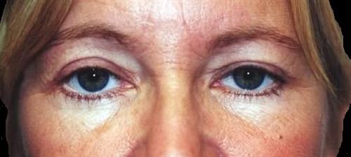 Eyelid Surgery Patient Photo - Case 31 - after view