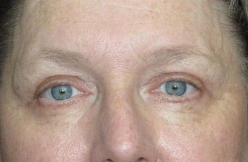 Eyelid Surgery Patient Photo - Case 47 - after view