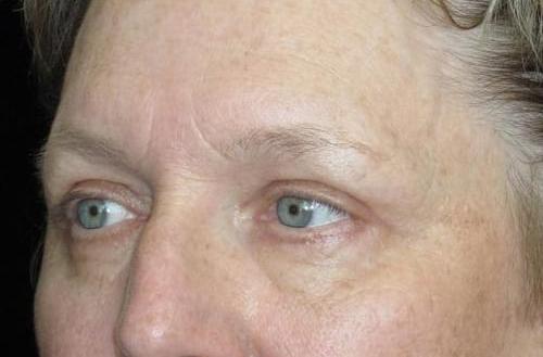 Eyelid Surgery Patient Photo - Case 47 - after view-1