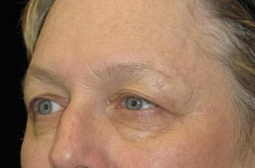 Eyelid Surgery Patient Photo - Case 47 - before view-1