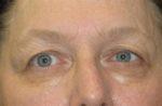 Eyelid Surgery - Case 47 - Before