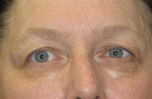Eyelid Surgery Patient Photo - Case 47 - before view-