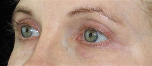 Eyelid Surgery Patient Photo - Case 46 - after view-1